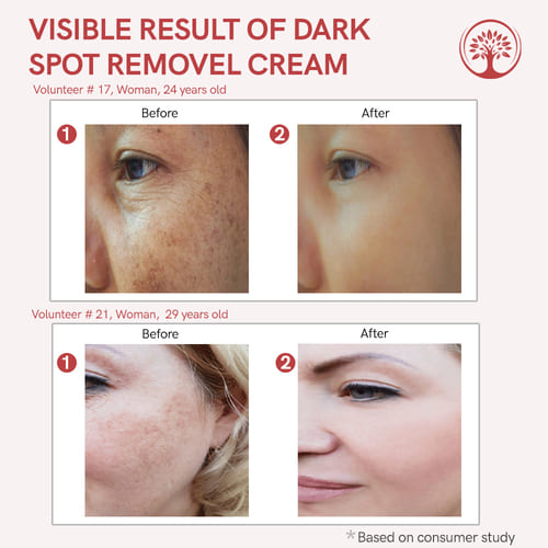 ivory natural dark spot removal face cream before after image